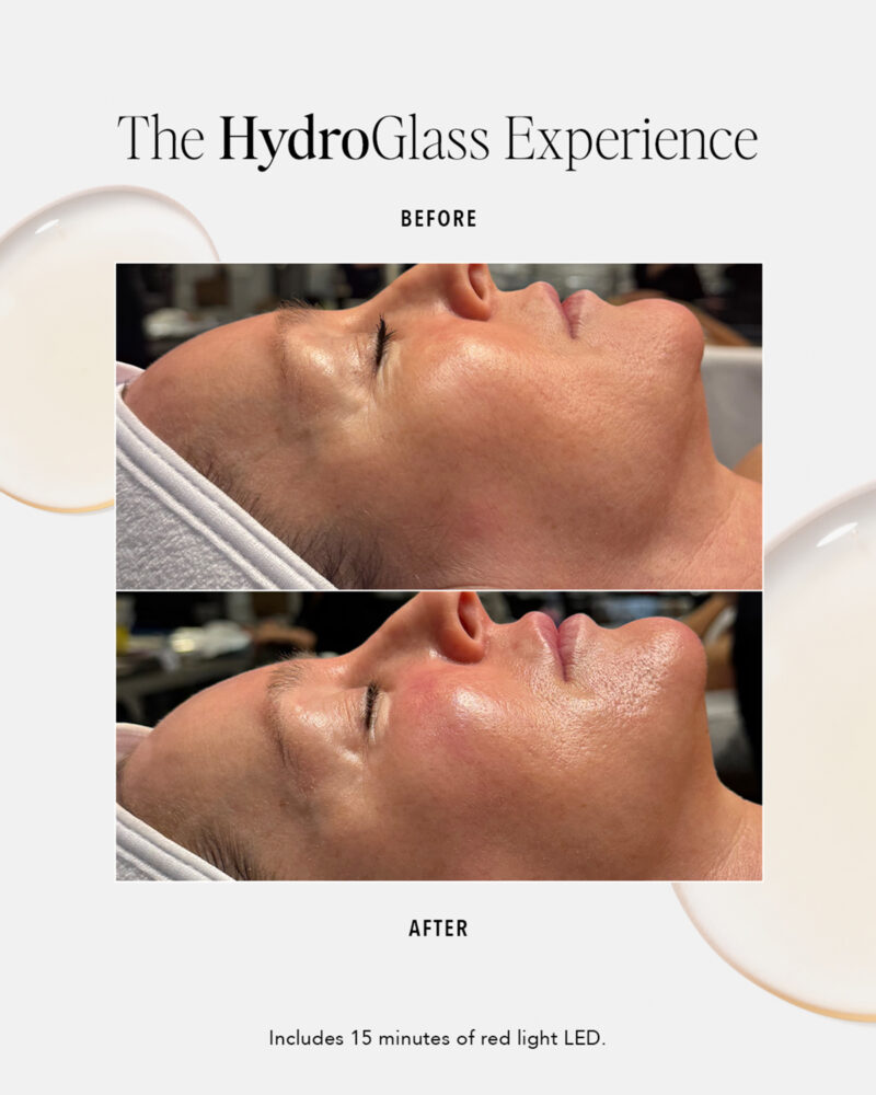 before and after image of the hydroglass facial treatment results