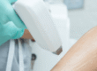 Laser hair removal procedure