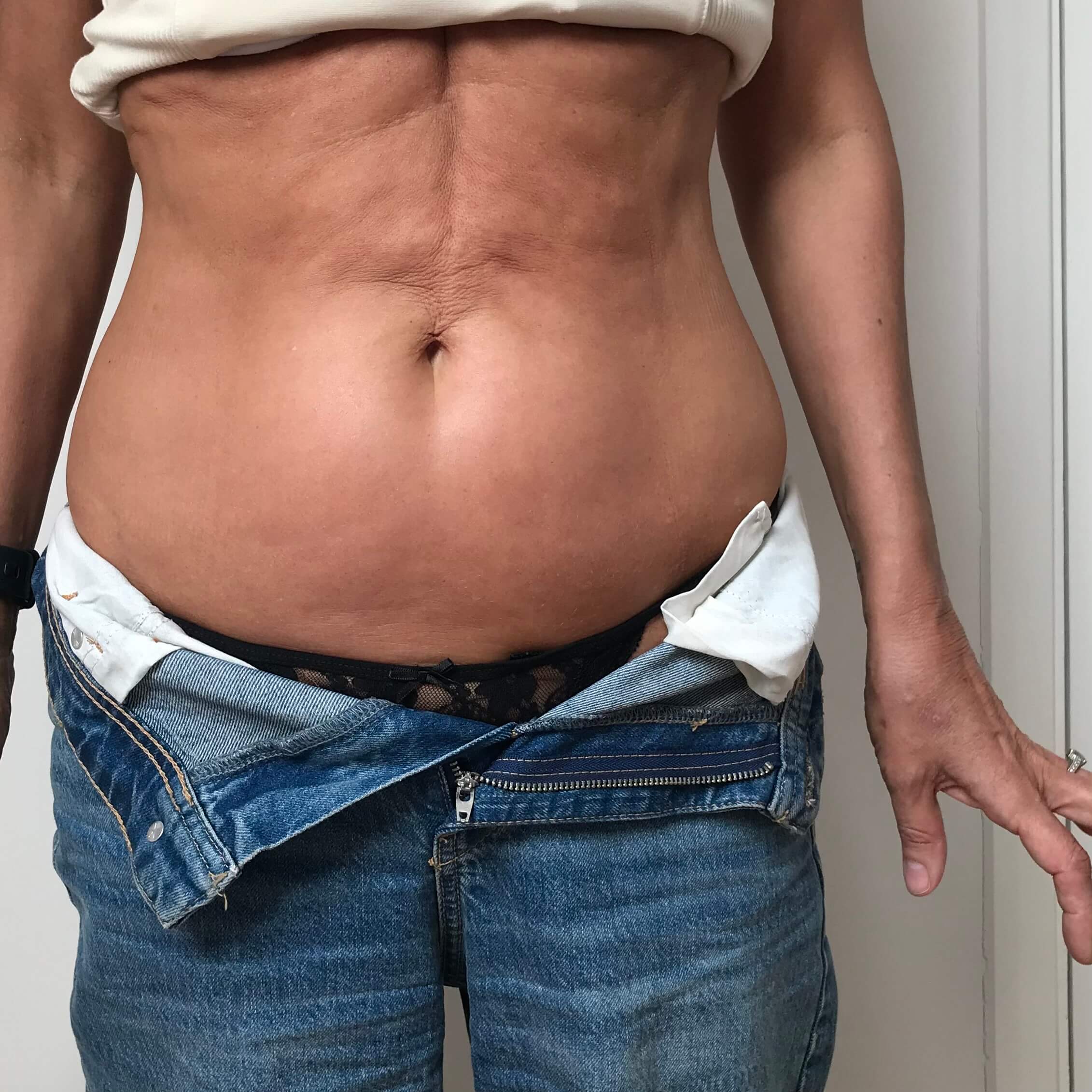 IMG-3083 (1) before 3D Lipo