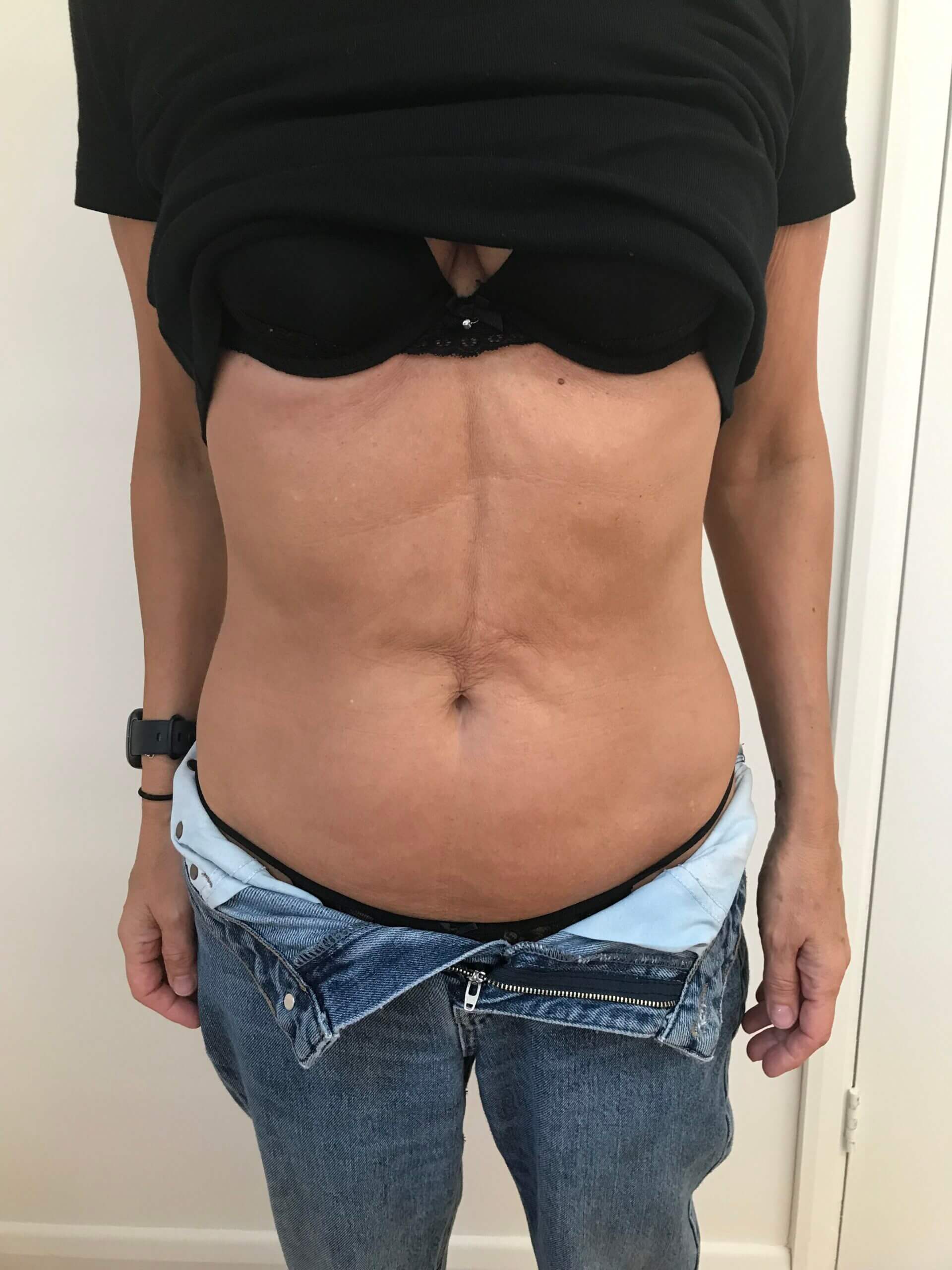 IMG-3555-scaled (1) After 3D Lipo