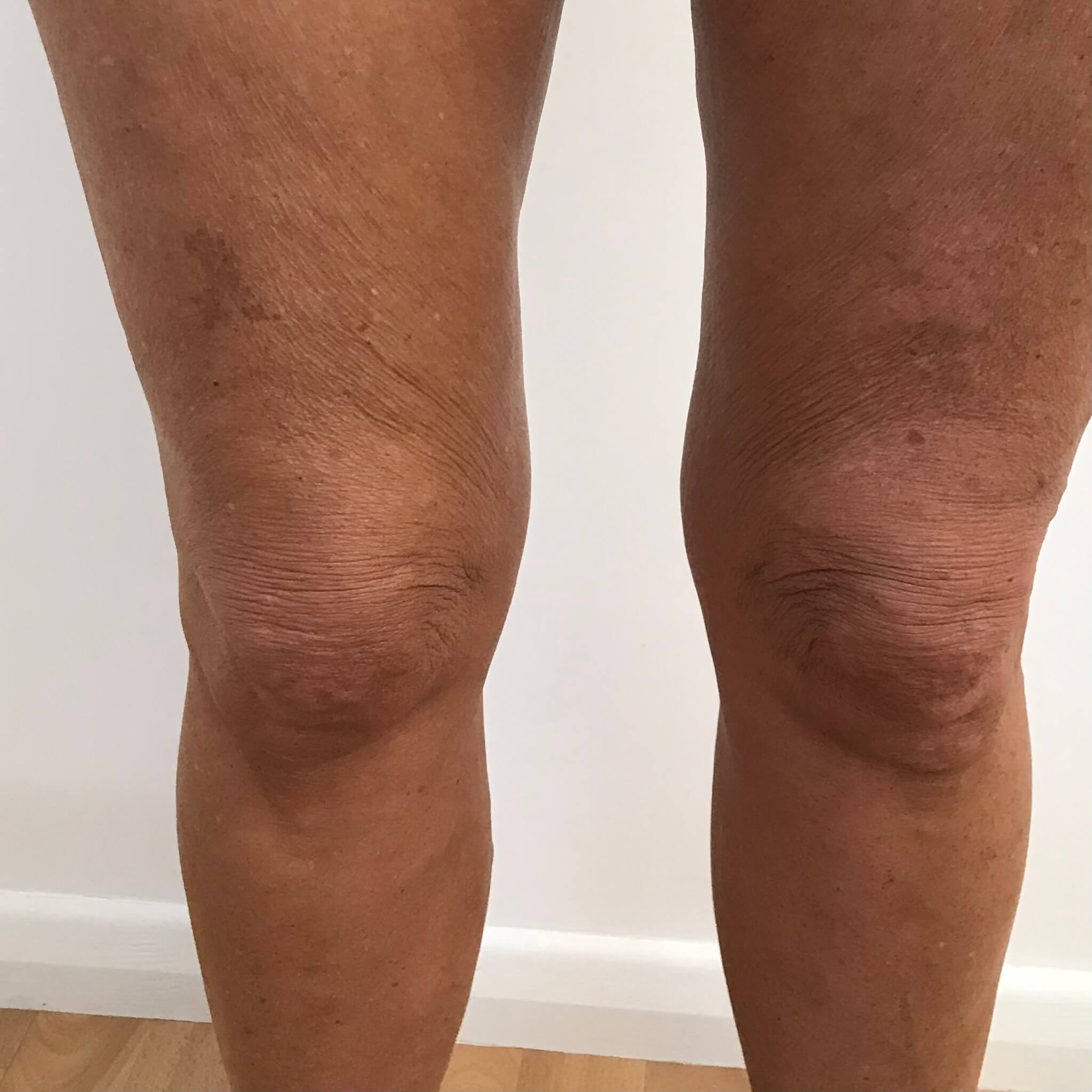 IMG-5114 (1) Legs before 3D Lipo Skin Tightening