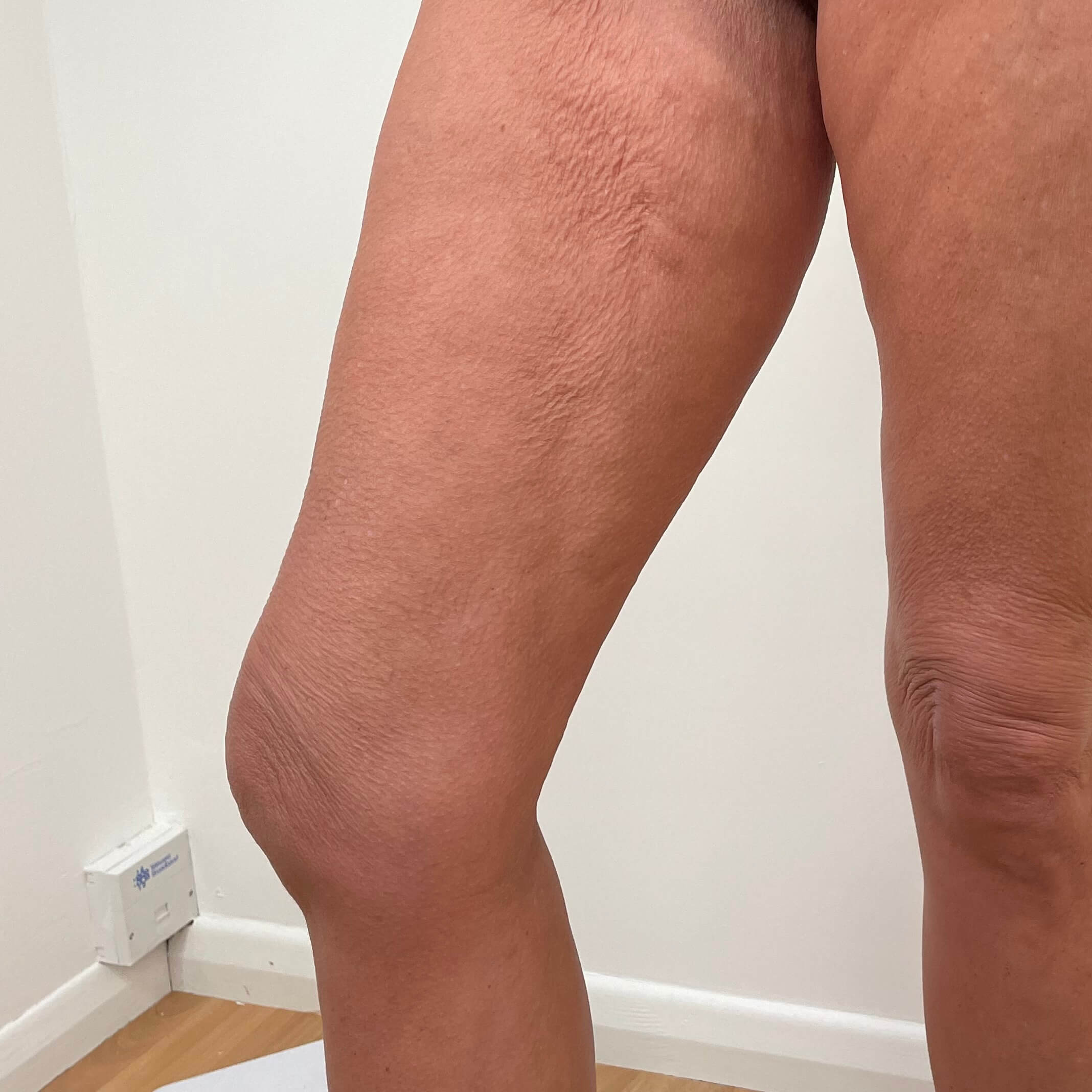 IMG-5493 (1) Legs before 3D Lipo Skin Tightening