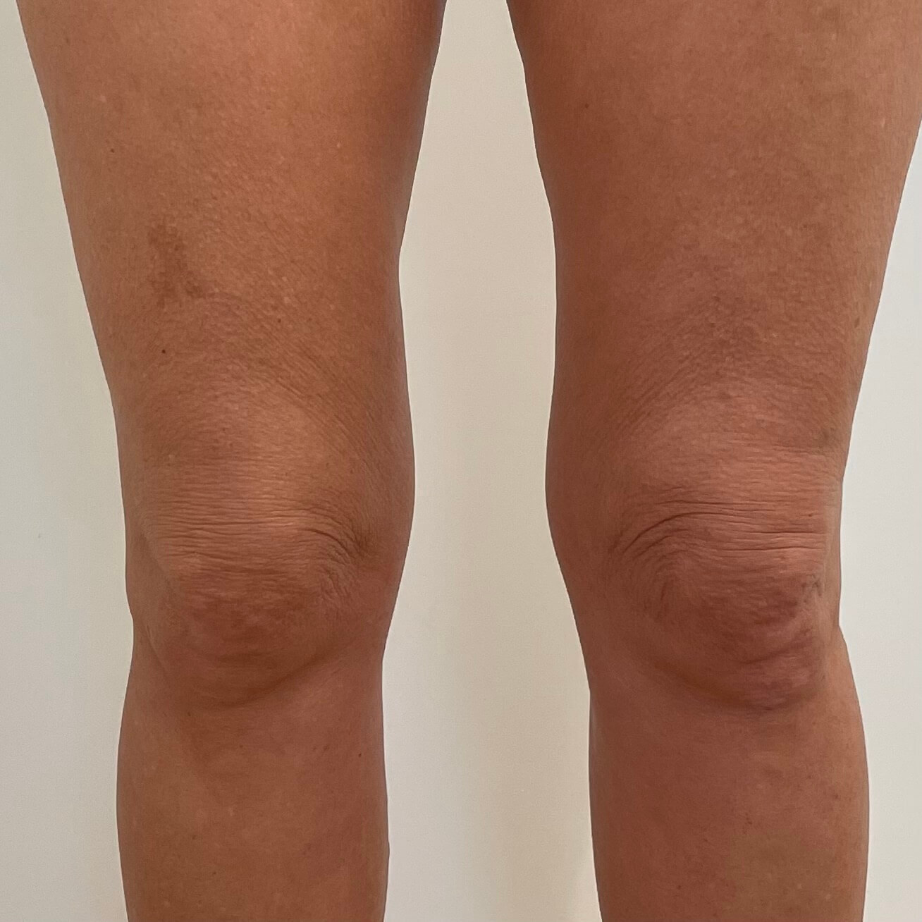 IMG-6293 (1) Legs after 3D Lipo Skin Tightening