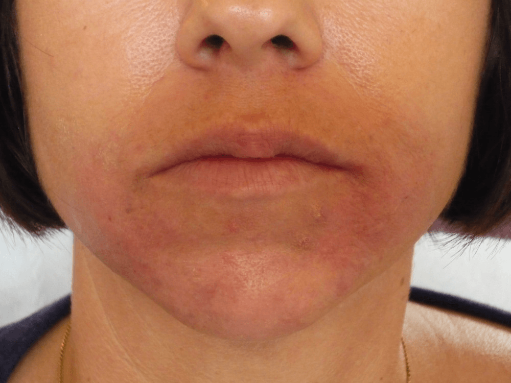 after-nasals (1) after nasals dermal fillers