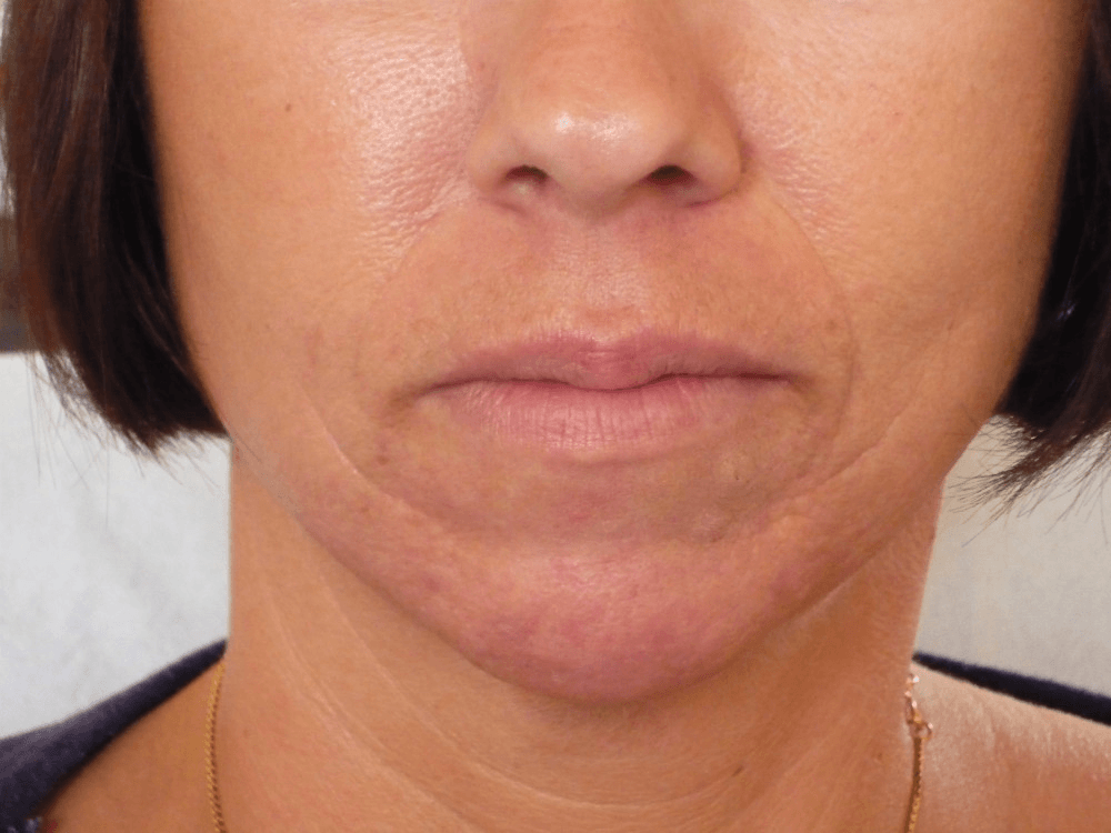 before-nasals (1) Before nasals dermal filler