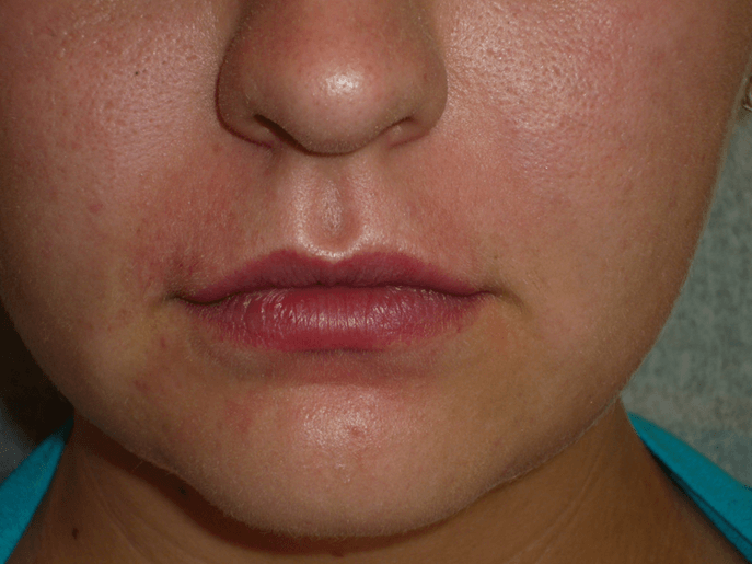 lips1-after (1) After lips dermal filler