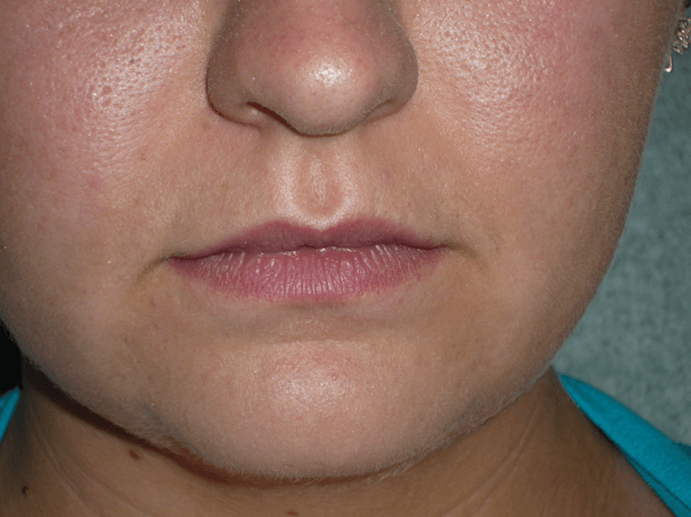 lips1-before (1) Before lips dermal filler