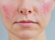 woman with facial redness