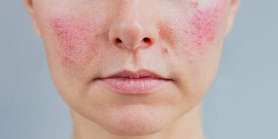 Facial Redness Blog Kent Laser (1) woman with facial redness