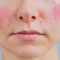 woman with facial redness